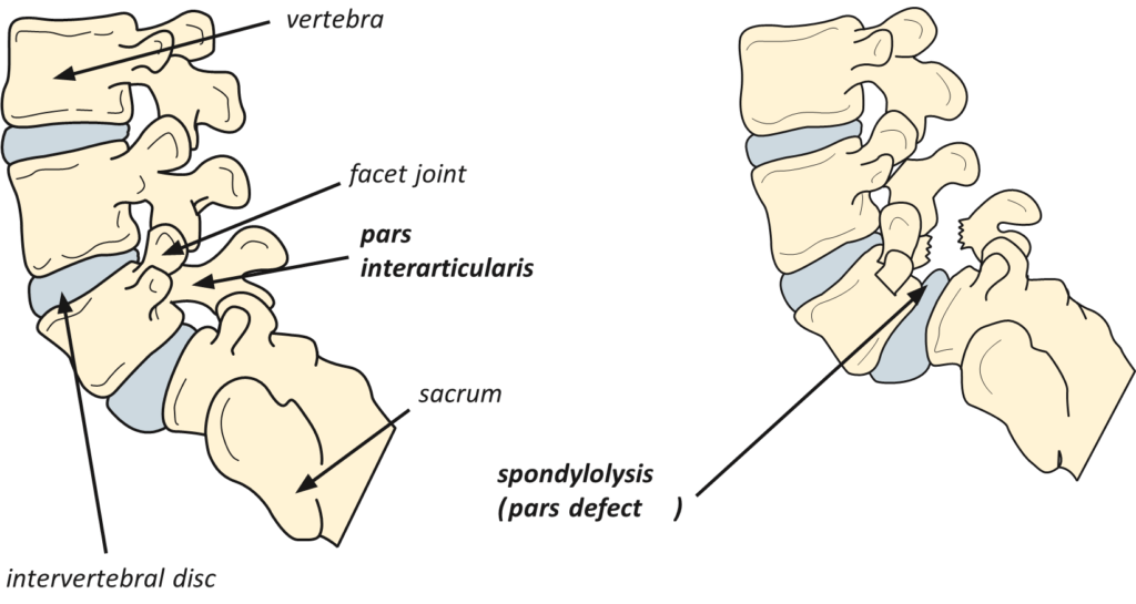 Pars Defect Injection Pars Injection for Lumbar Spondylolysis - drpranawkumar.com