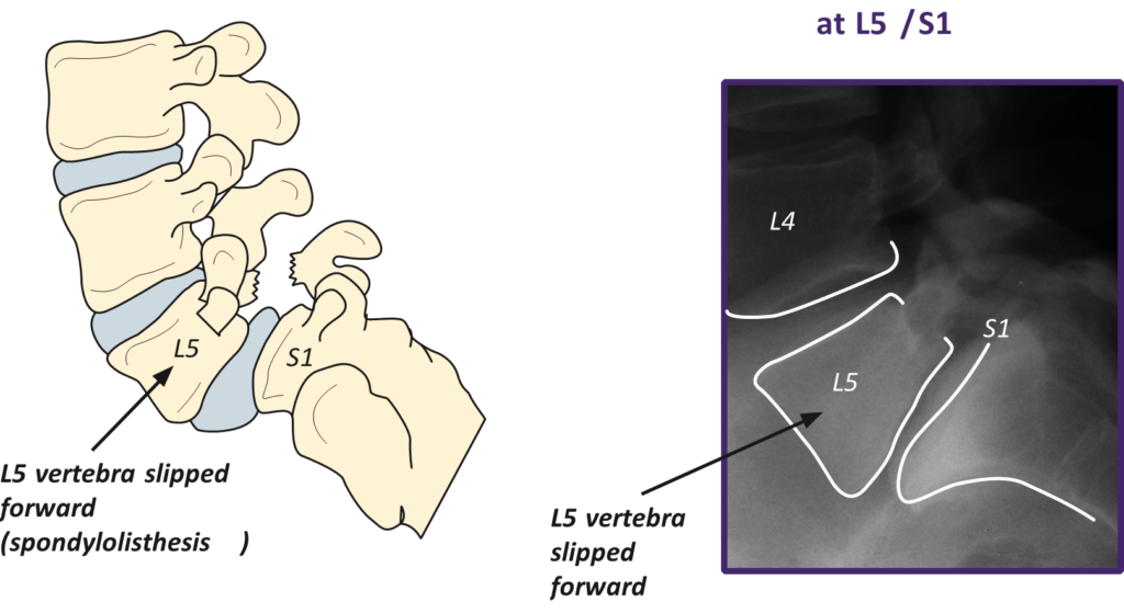 Pars Block Injection Pars Injection for Lumbar Spondylolysis - drpranawkumar.com