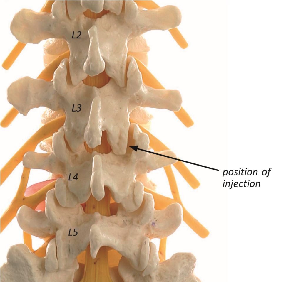 Lumbar Facet Joint Injection - drpranawkumar.com